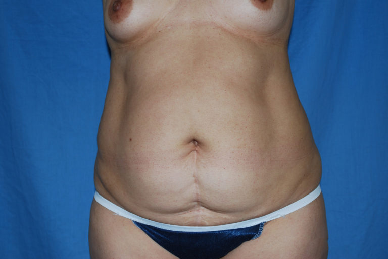 Liposuction - Case 3370 - Before