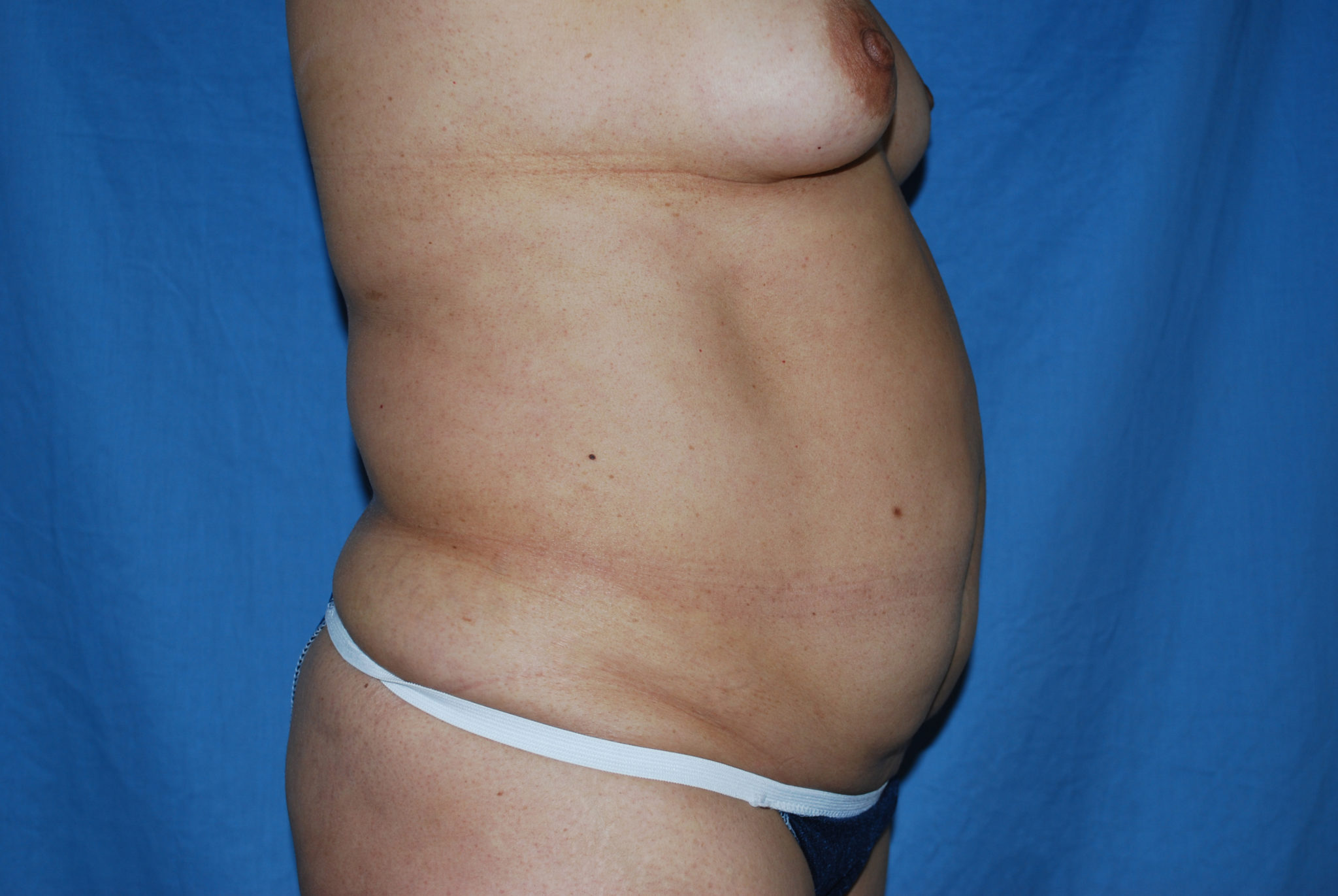 Liposuction Patient Photo - Case 3370 - before view-3