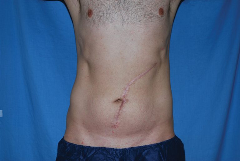Liposuction - Case 4706 - Before