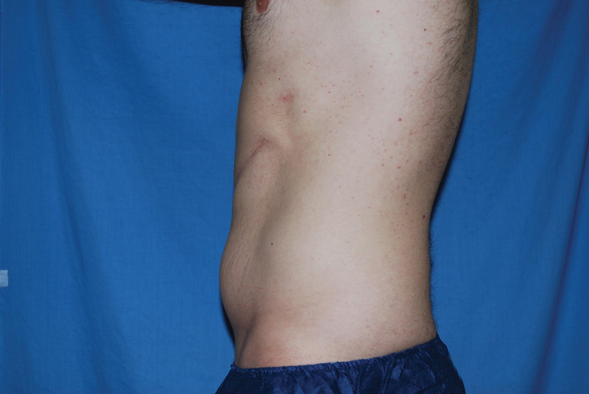 Liposuction Patient Photo - Case 4706 - before view-4