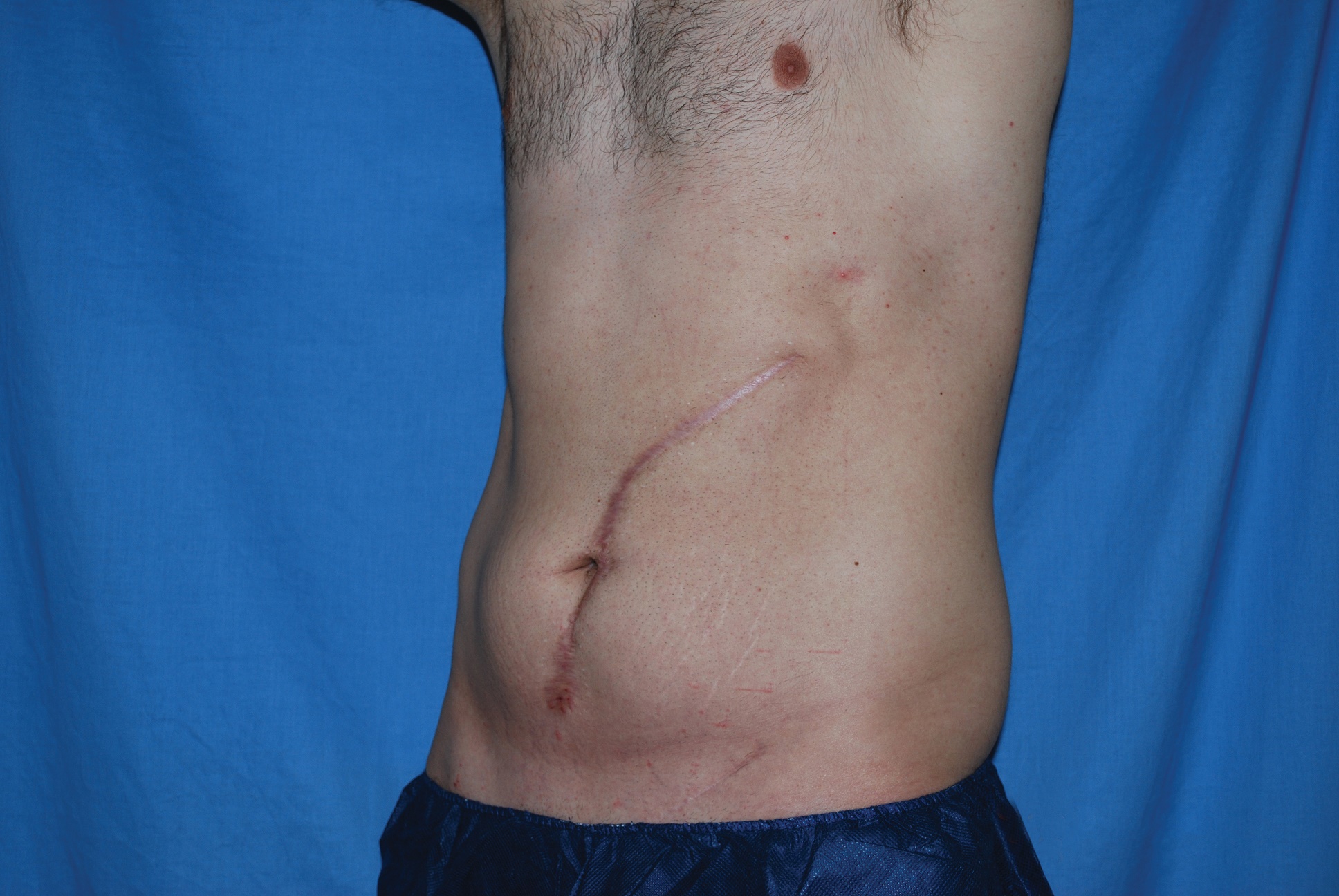 Liposuction Patient Photo - Case 4706 - before view-2