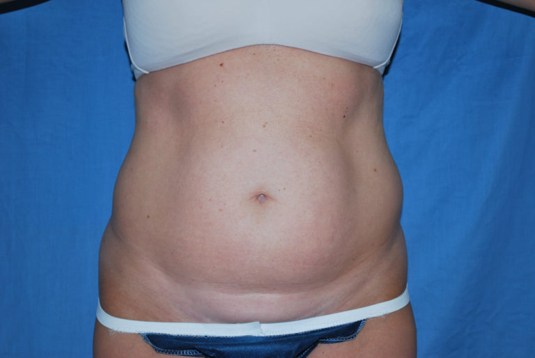 Liposuction - Case 2990 - Before