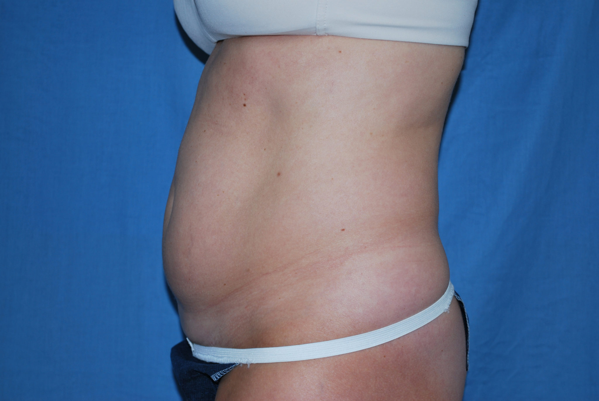 Liposuction Patient Photo - Case 2990 - before view-1