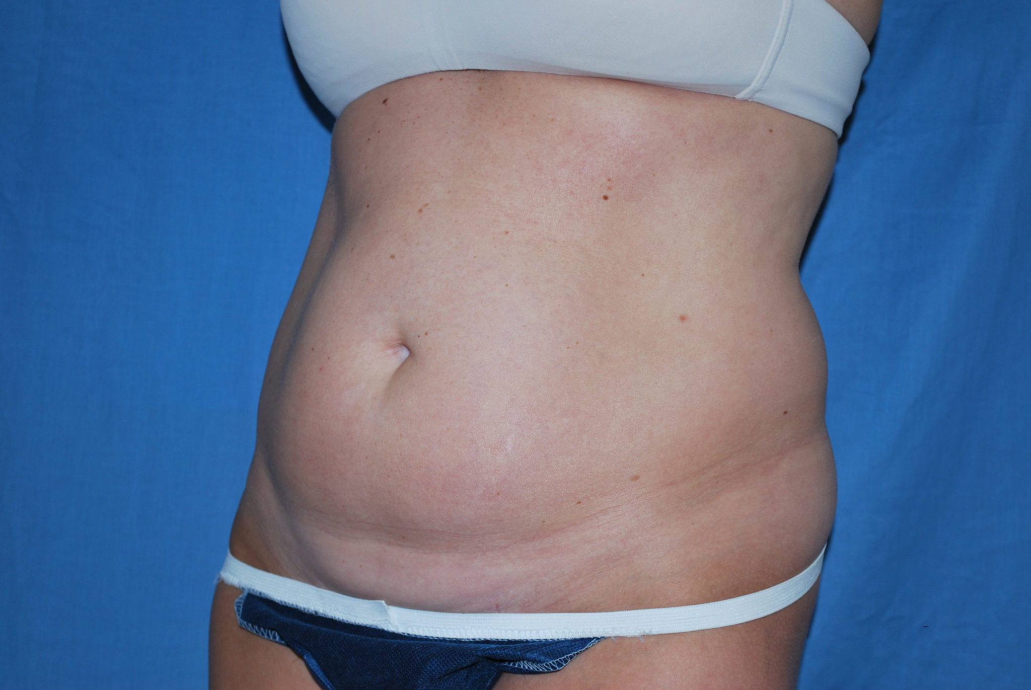 Liposuction Patient Photo - Case 2990 - before view-2