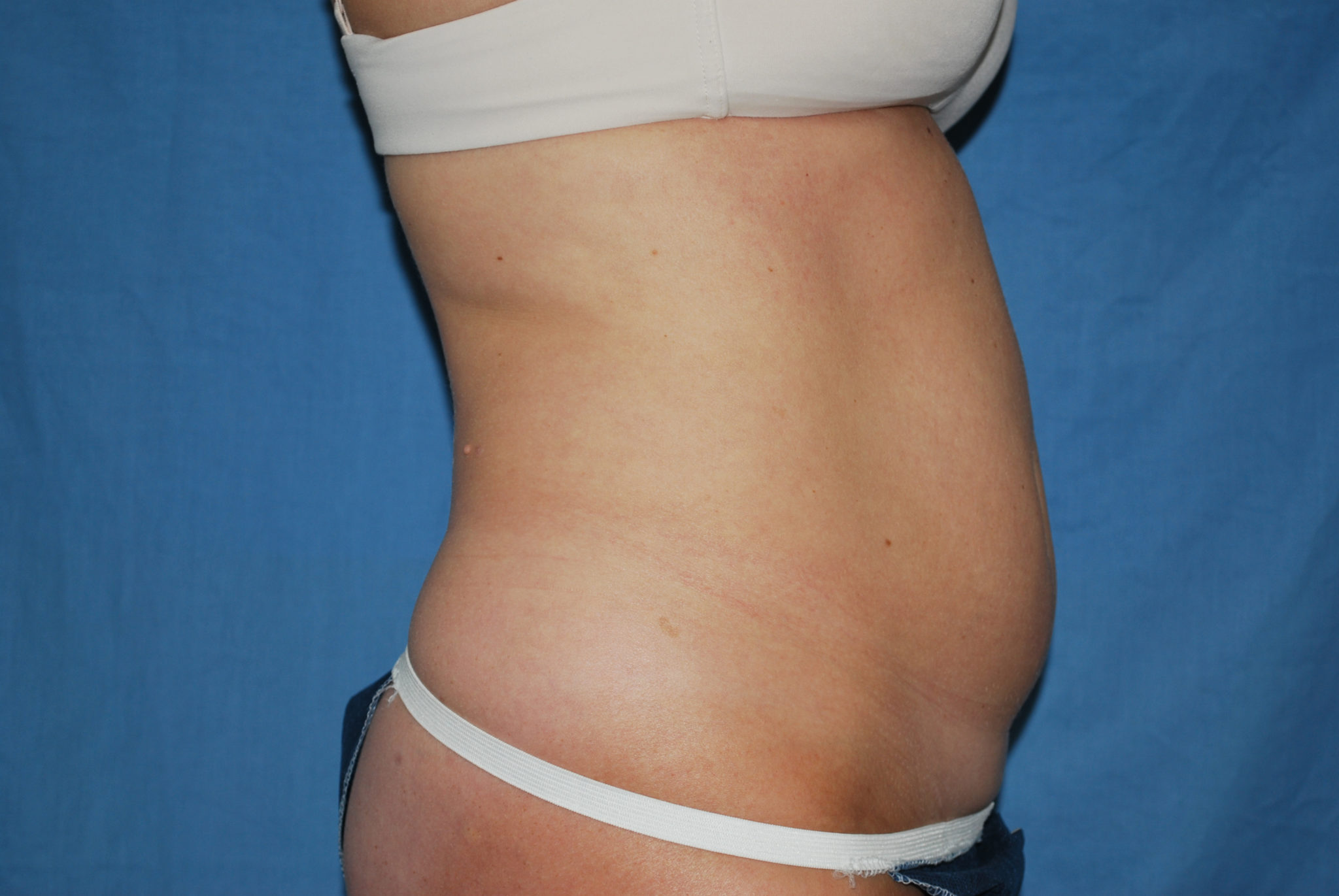 Liposuction Patient Photo - Case 2990 - before view-3