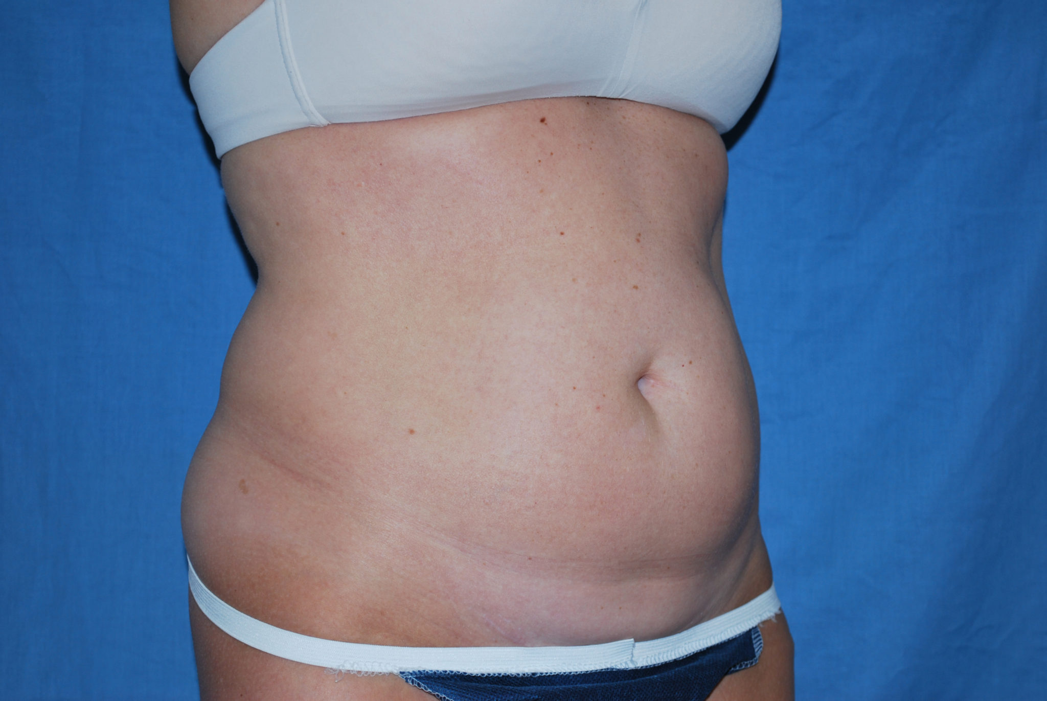 Liposuction Patient Photo - Case 2990 - before view-4