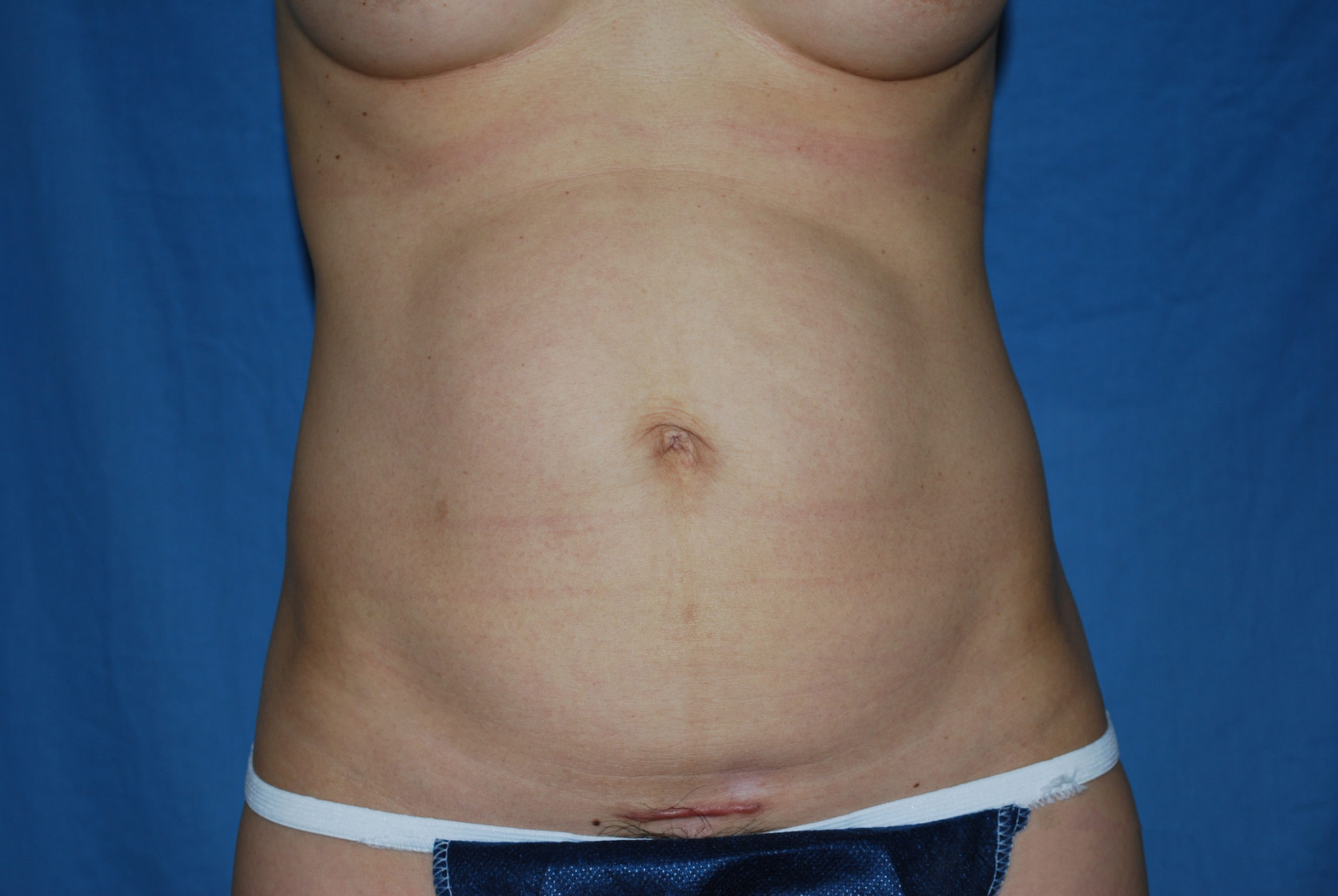Tummy Tuck Patient Photo - Case 3433 - before view-