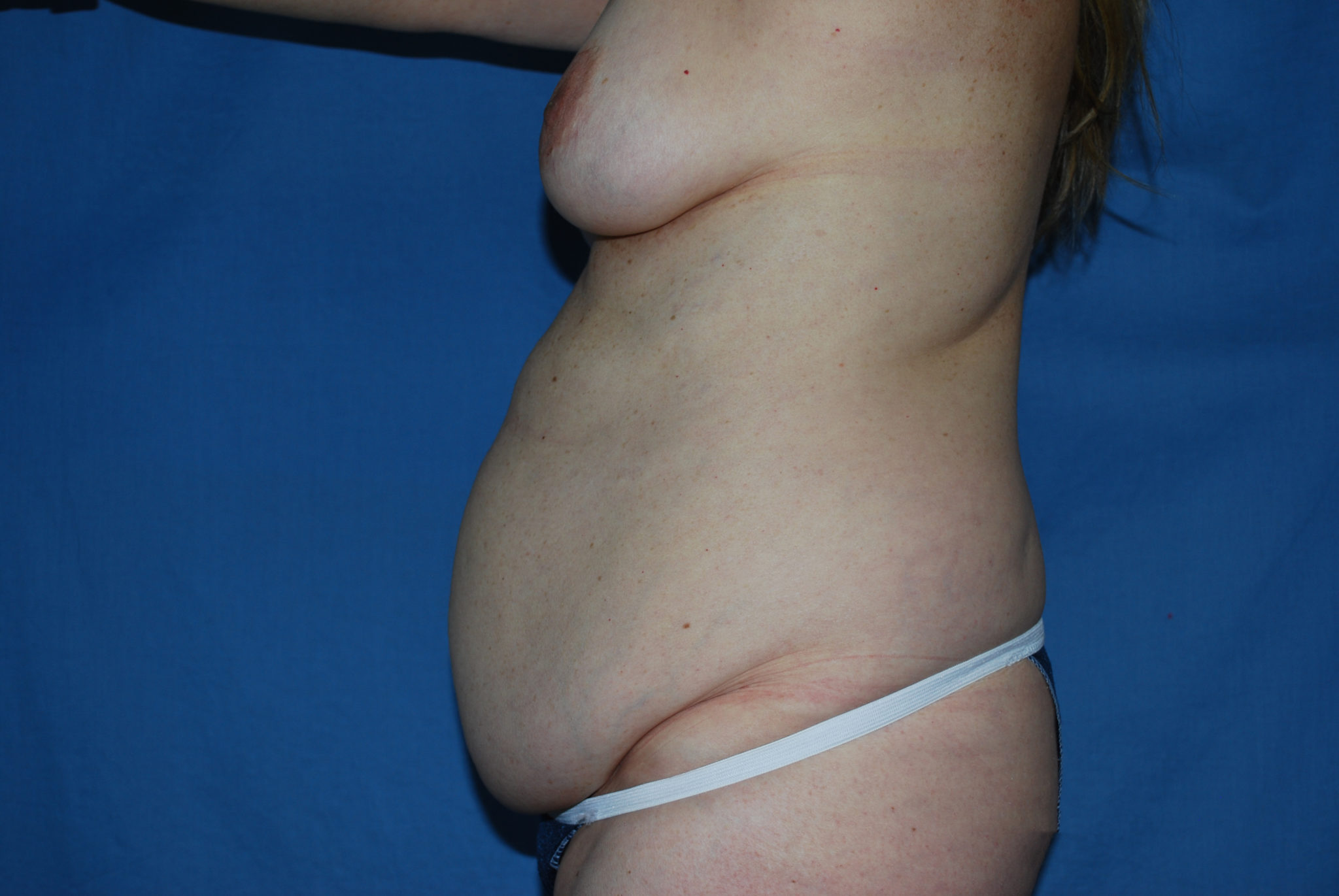 Tummy Tuck Patient Photo - Case 3454 - before view-1