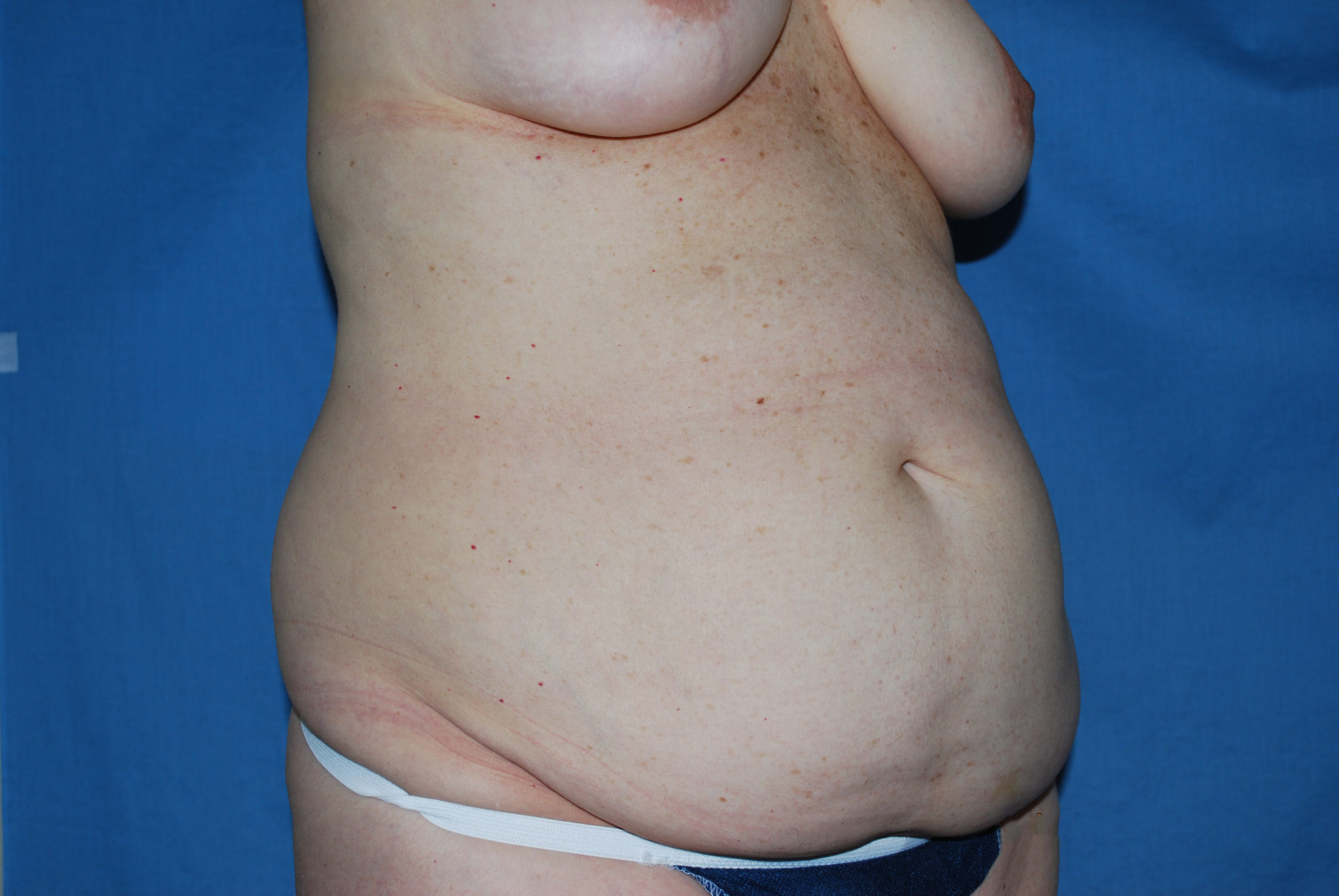 Tummy Tuck Patient Photo - Case 3454 - before view-4