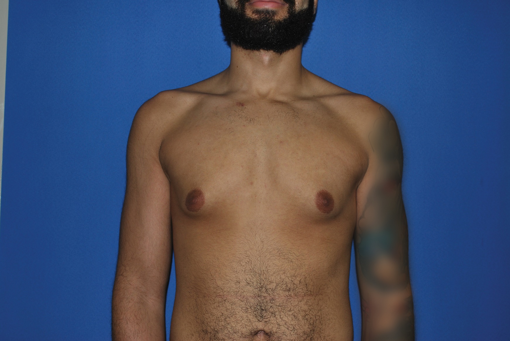 Male Breast Reduction Patient Photo - Case 5035 - before view-0