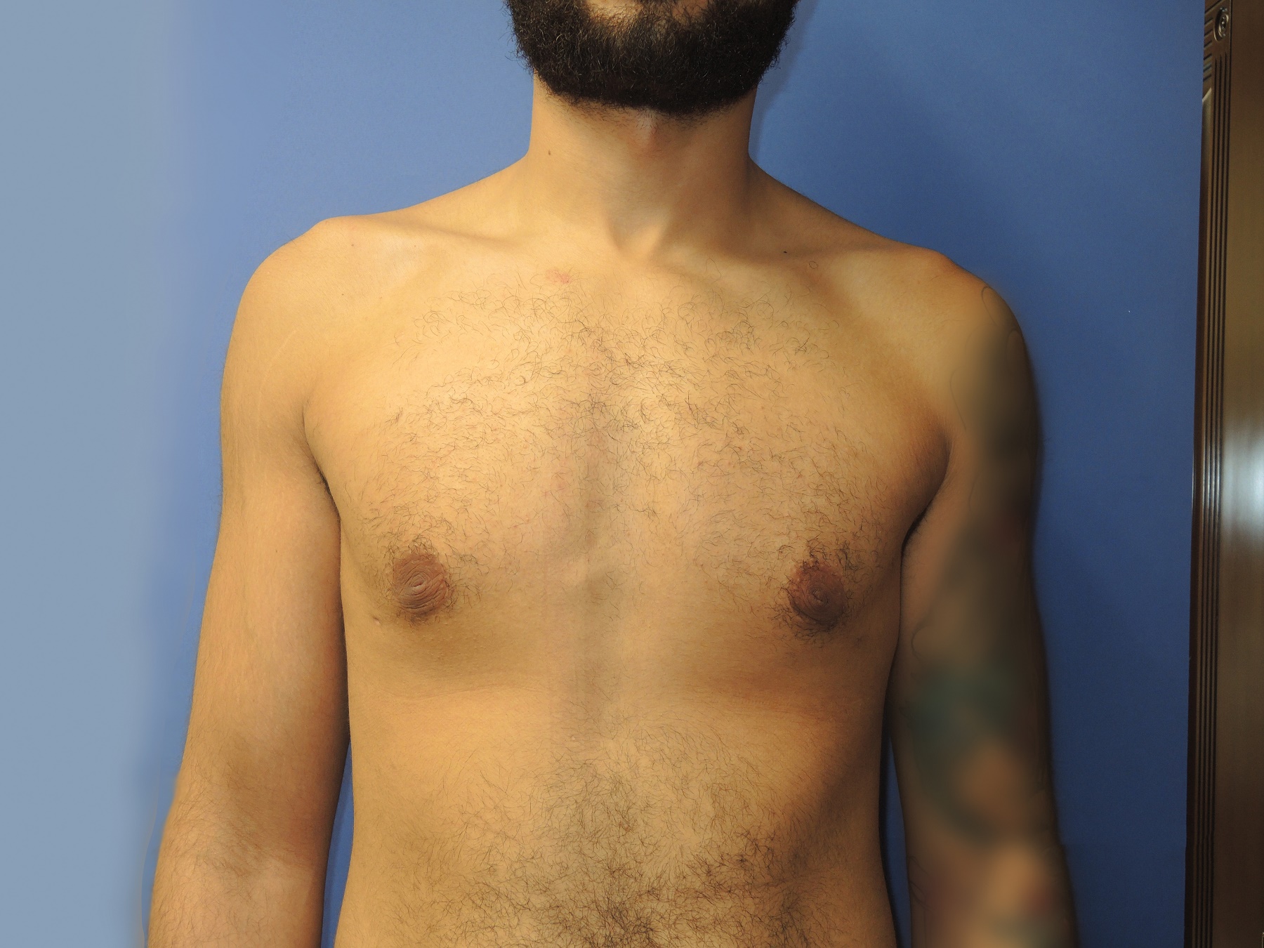 Male Breast Reduction Patient Photo - Case 5035 - after view-0