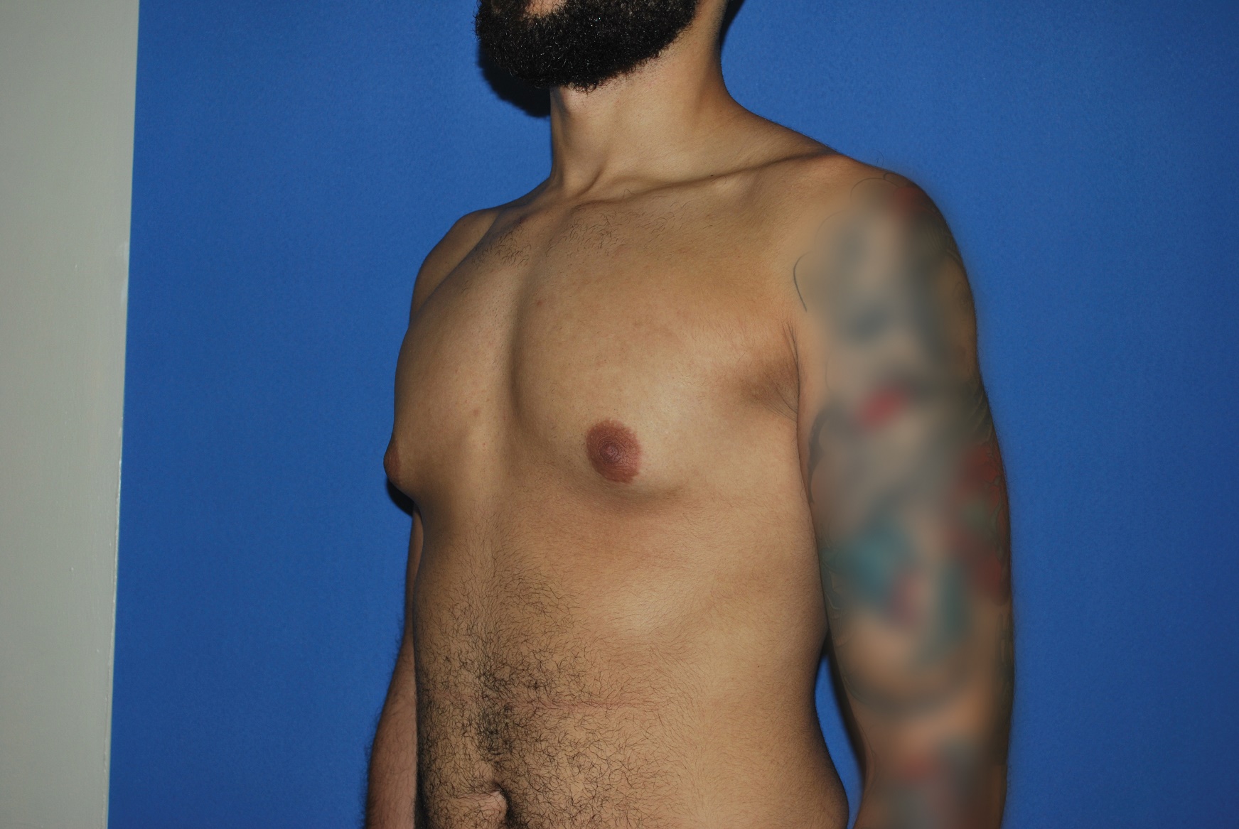 Male Breast Reduction Patient Photo - Case 5035 - before view-1