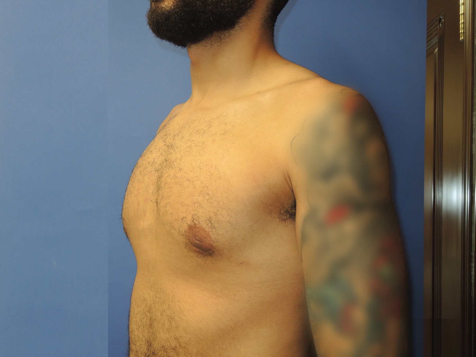 Male Breast Reduction Patient Photo - Case 5035 - after view-2