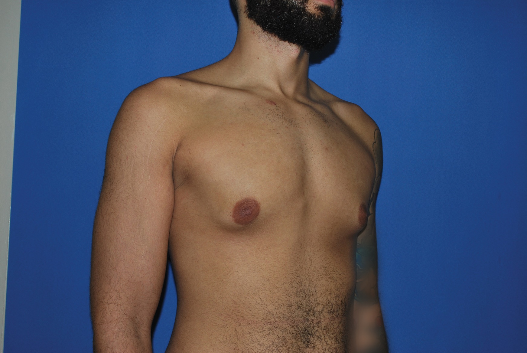 Male Breast Reduction Patient Photo - Case 5035 - before view-1