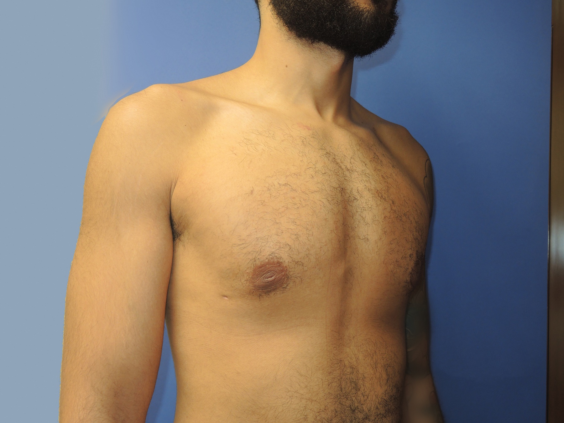 Male Breast Reduction Patient Photo - Case 5035 - after view-1