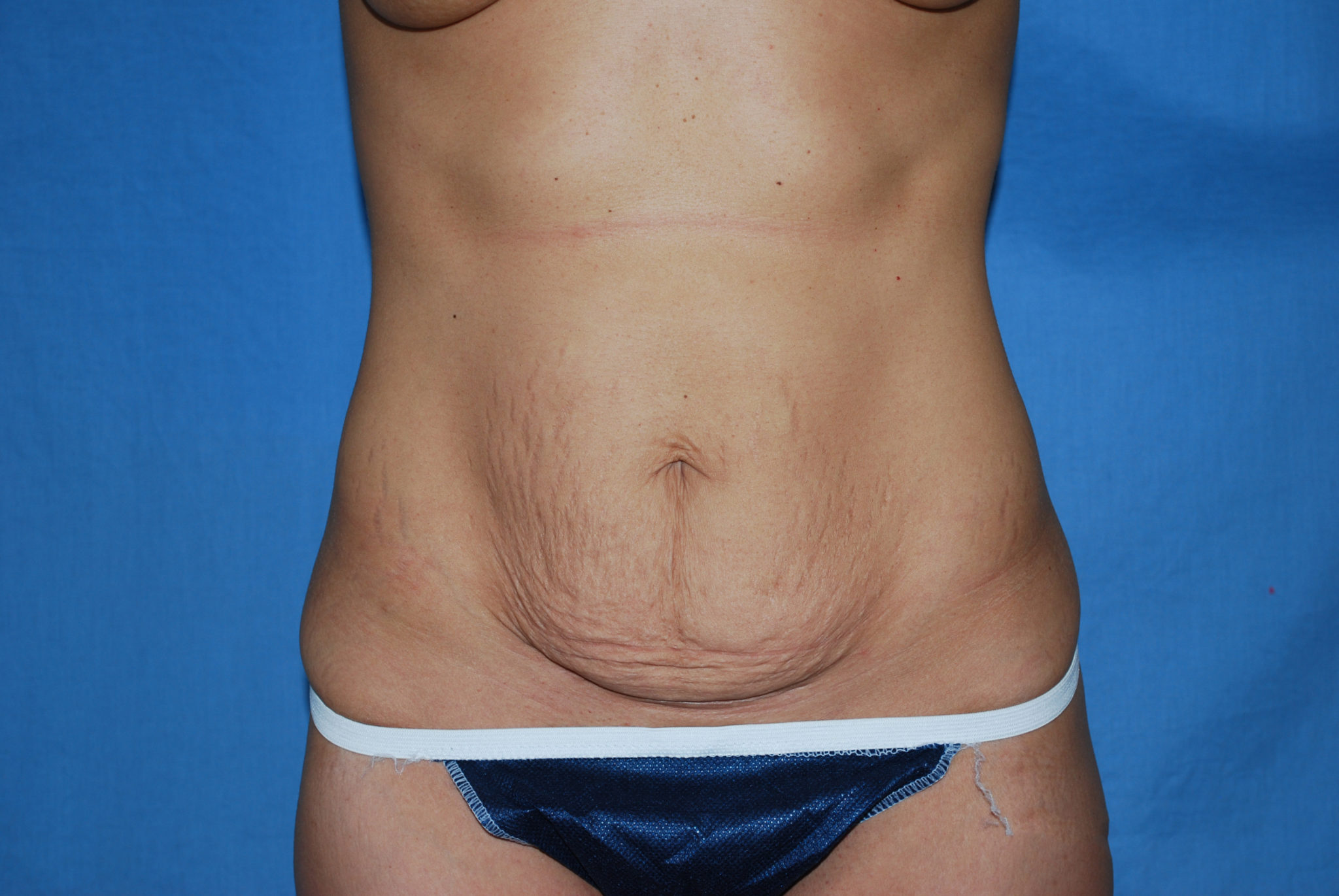 Tummy Tuck Patient Photo - Case 3297 - before view-