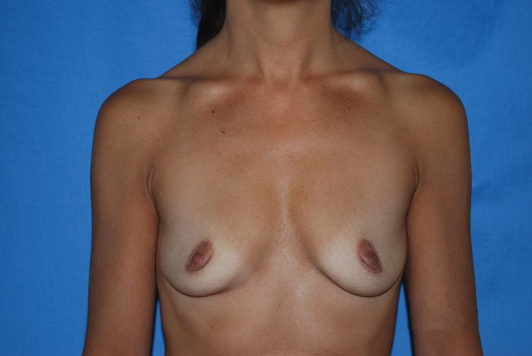 Breast Augmentation - Case 4306 - Before