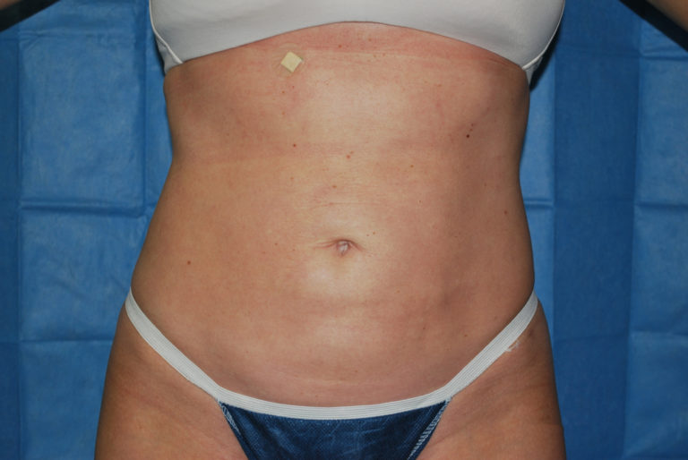 Liposuction - Case 2990 - After