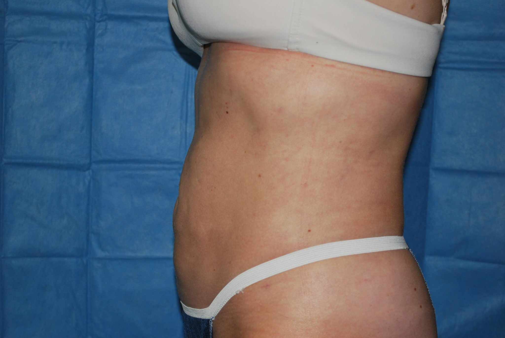 Liposuction Patient Photo - Case 2990 - after view-1