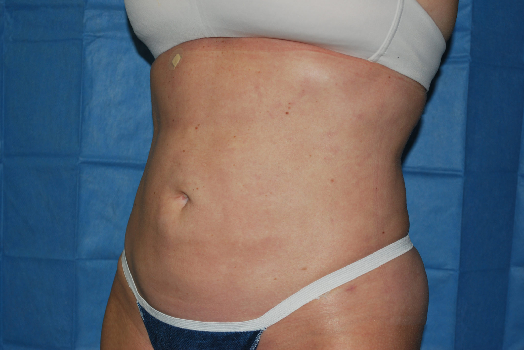 Liposuction Patient Photo - Case 2990 - after view-2
