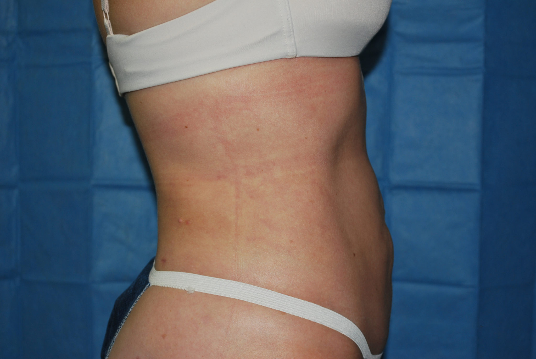 Liposuction Patient Photo - Case 2990 - after view-3