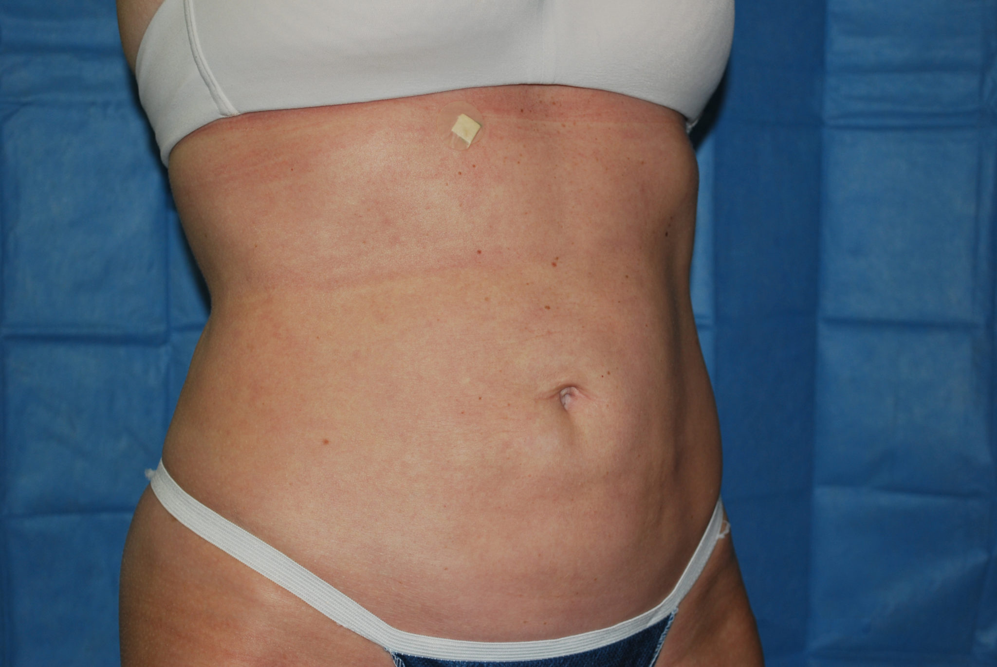 Liposuction Patient Photo - Case 2990 - after view-4