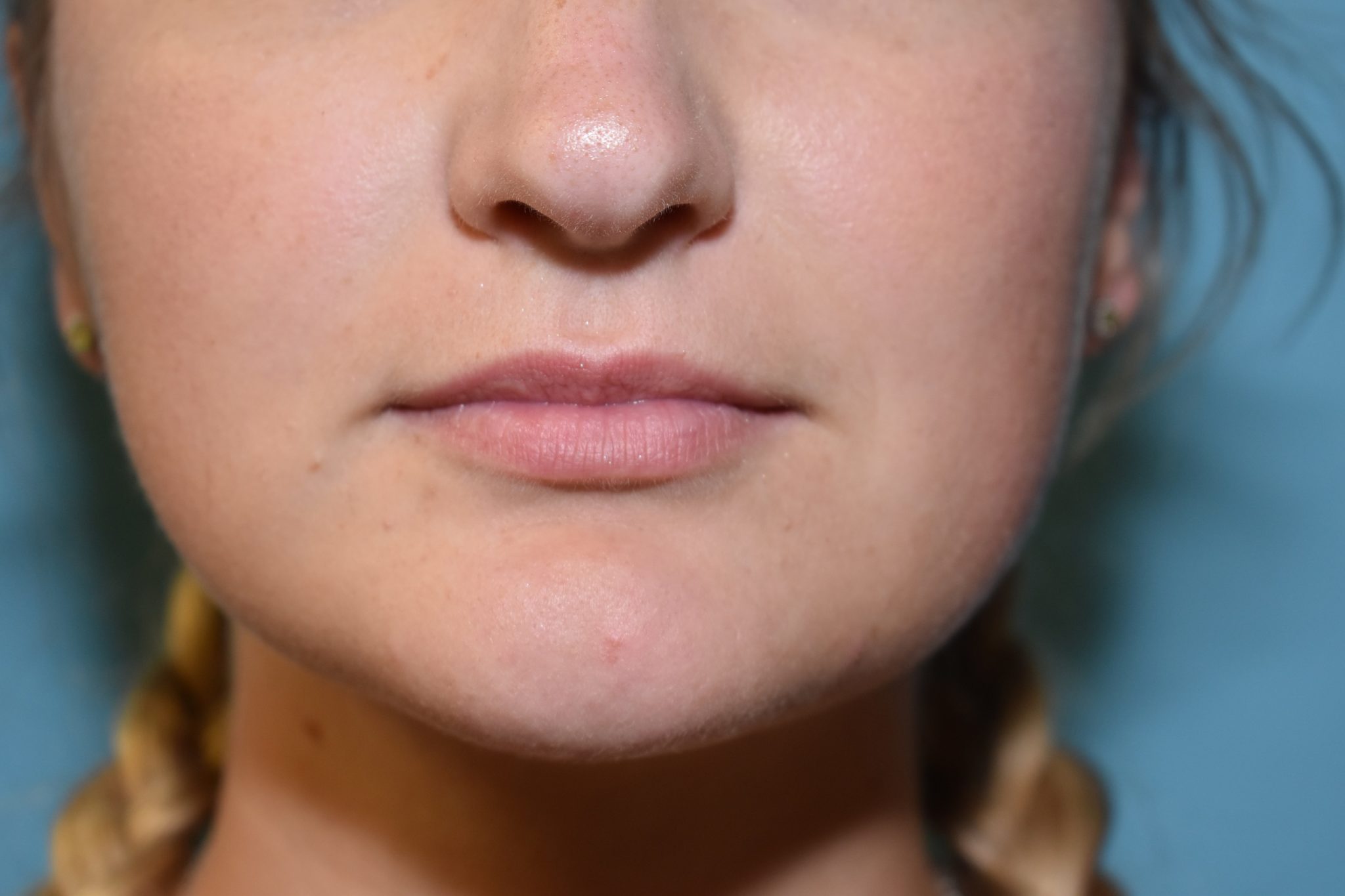 Fillers Patient Photo - Case 5202 - before view-0