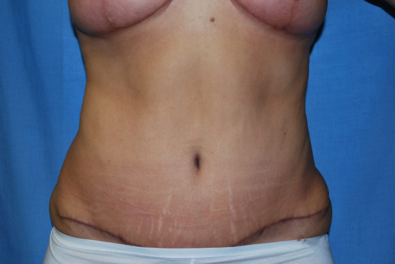 Liposuction - Case 3405 - After