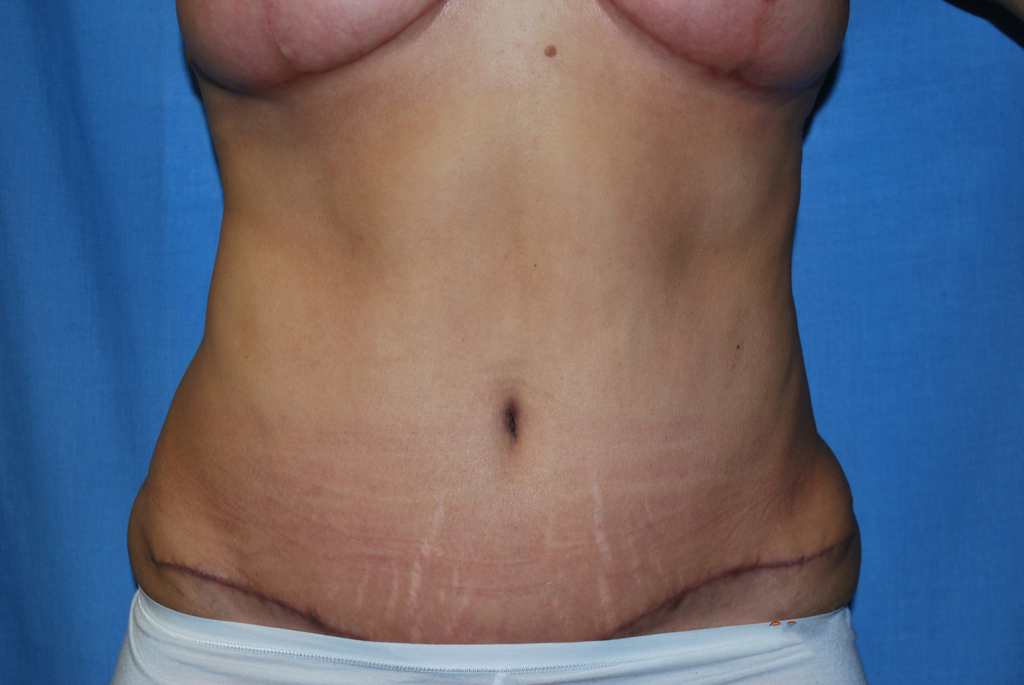 Liposuction Patient Photo - Case 3405 - after view