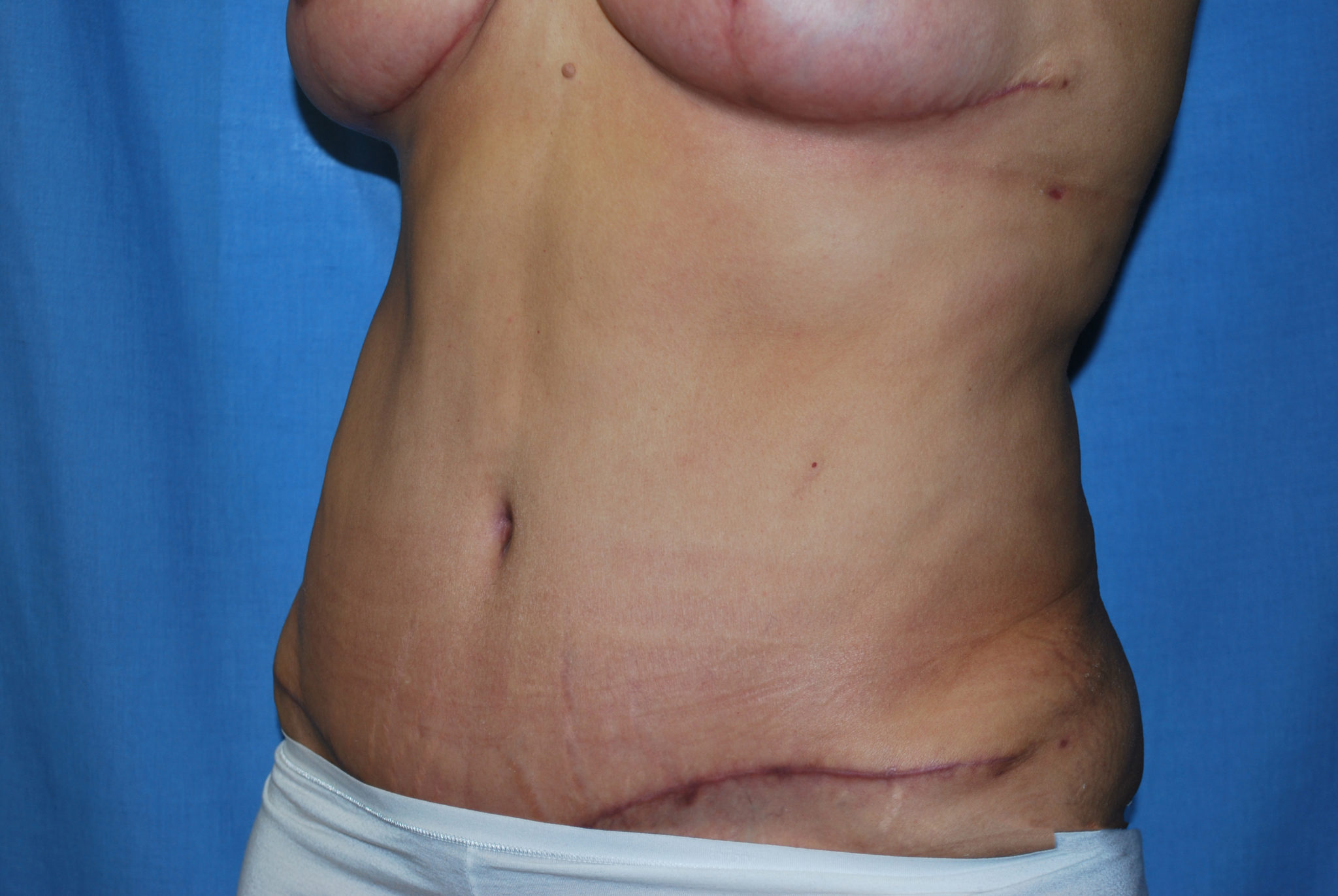 Liposuction Patient Photo - Case 3405 - after view-1