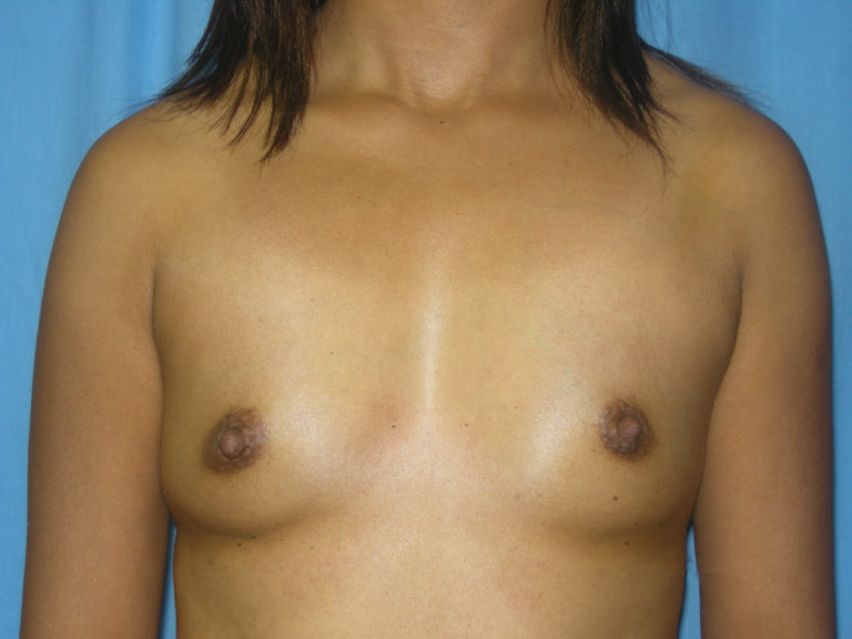 Breast Augmentation - Case 4254 - Before