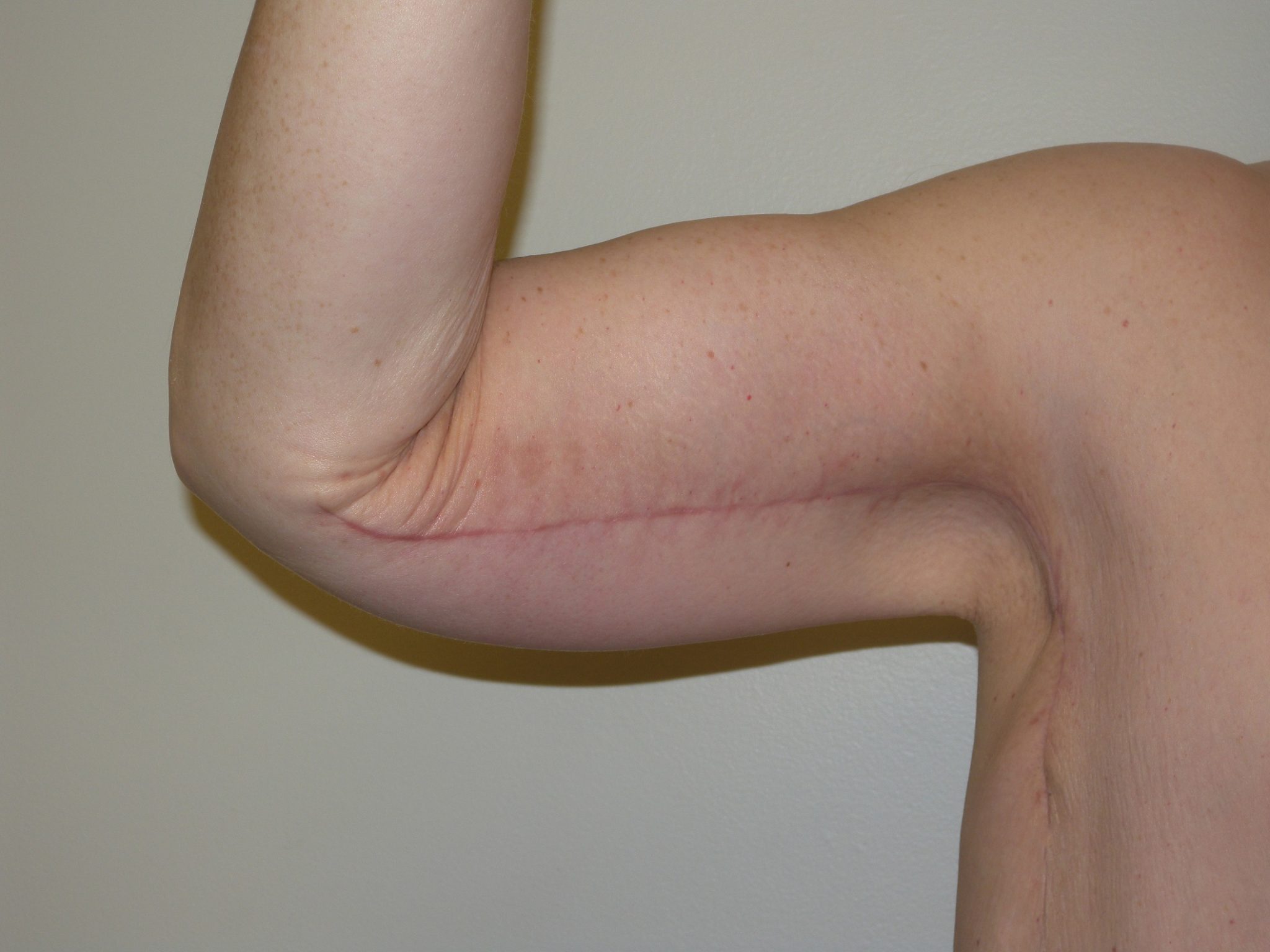 Arm Lift Patient Photo - Case 4218 - after view-1