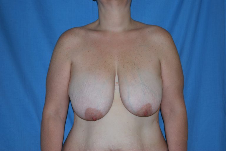 Breast Reduction - Case 4589 - Before