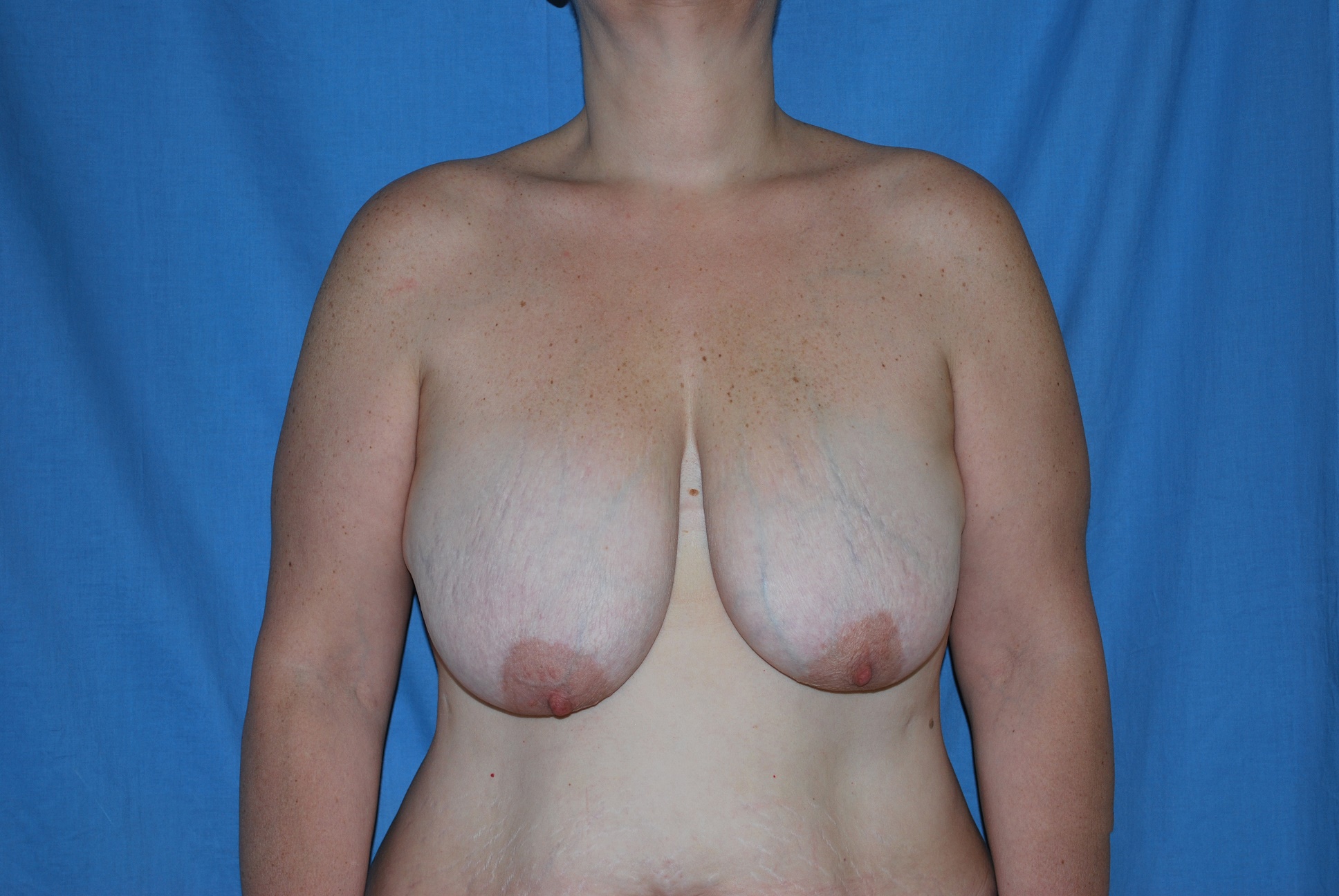 Breast Reduction Patient Photo - Case 4589 - before view-