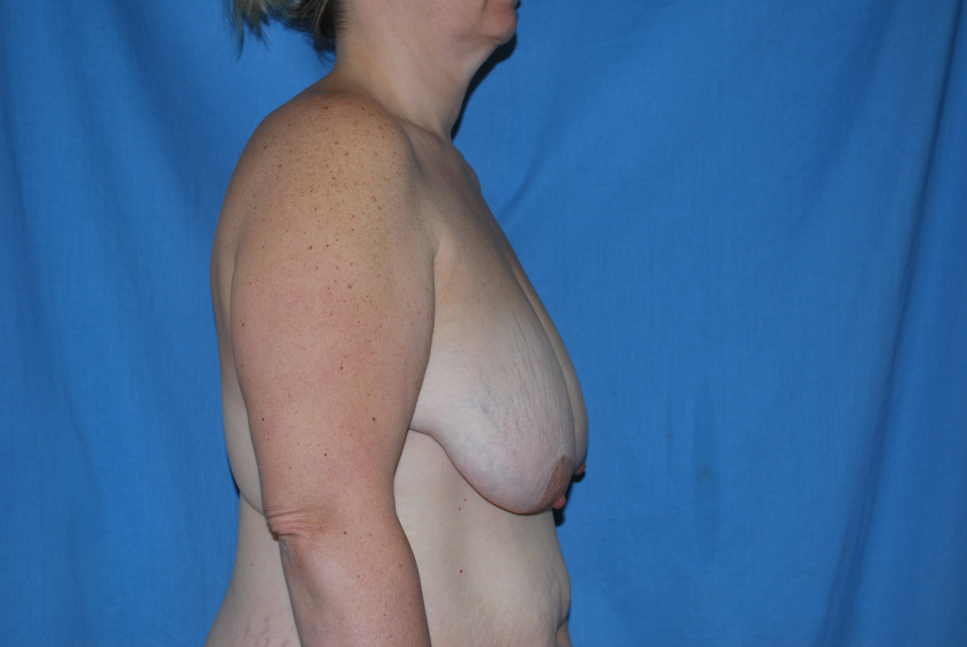 Breast Reduction Patient Photo - Case 4589 - before view-2