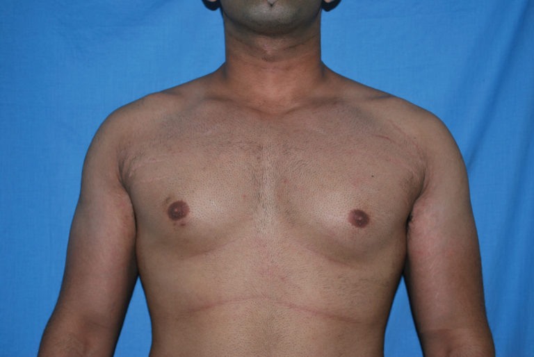 Male Breast Reduction - Case 5042 - Before