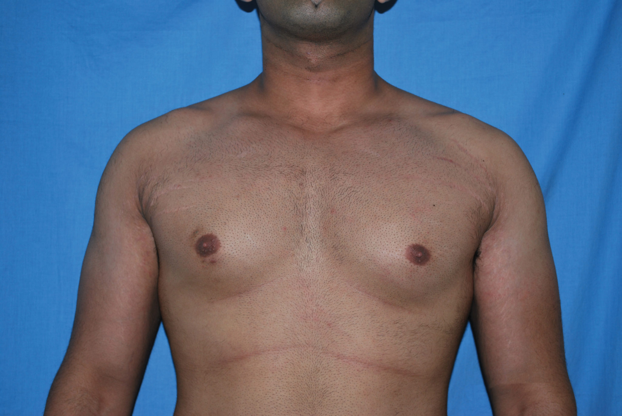 Male Breast Reduction Patient Photo - Case 5042 - before view-0