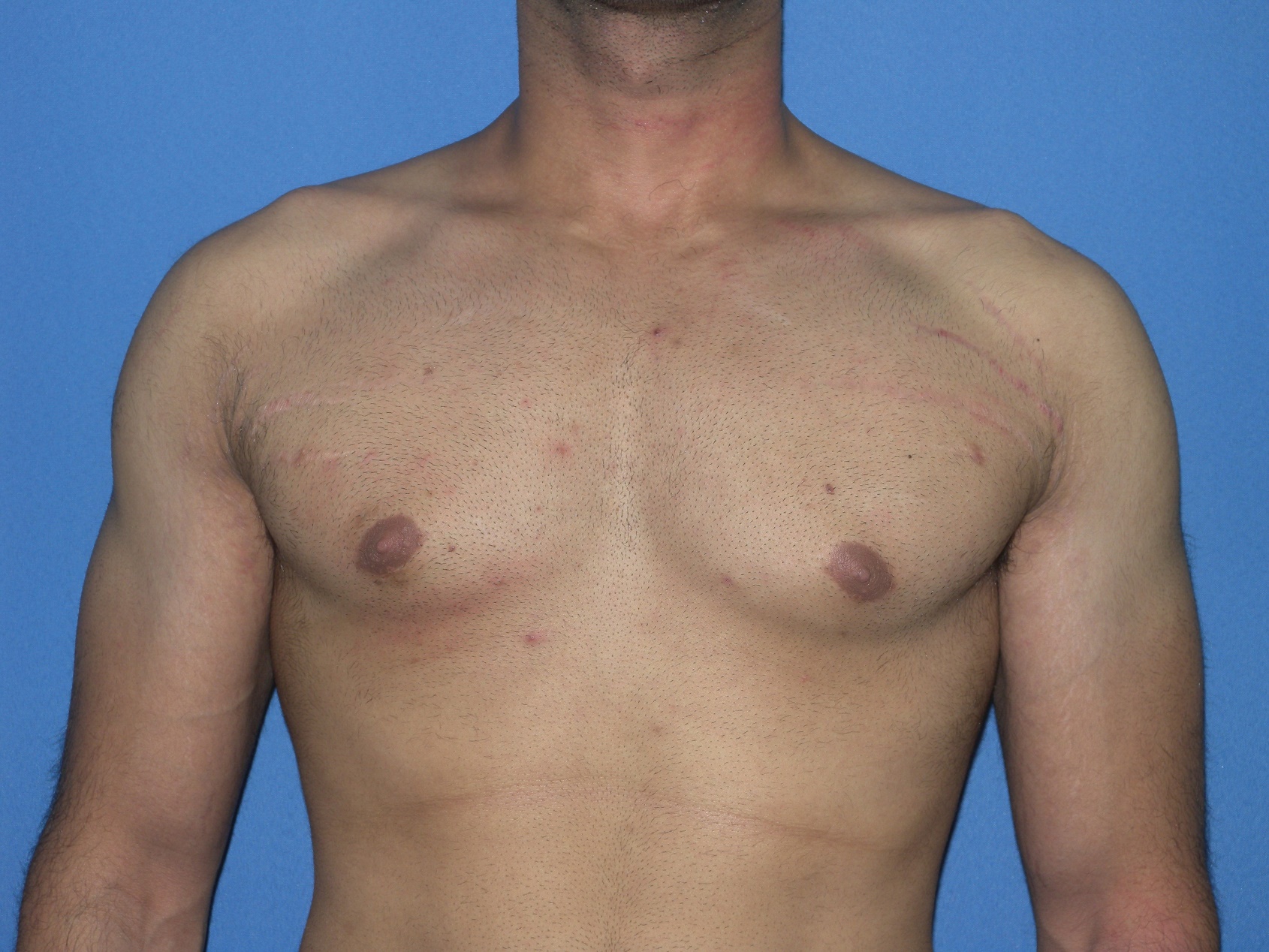 Male Breast Reduction Patient Photo - Case 5042 - after view-0