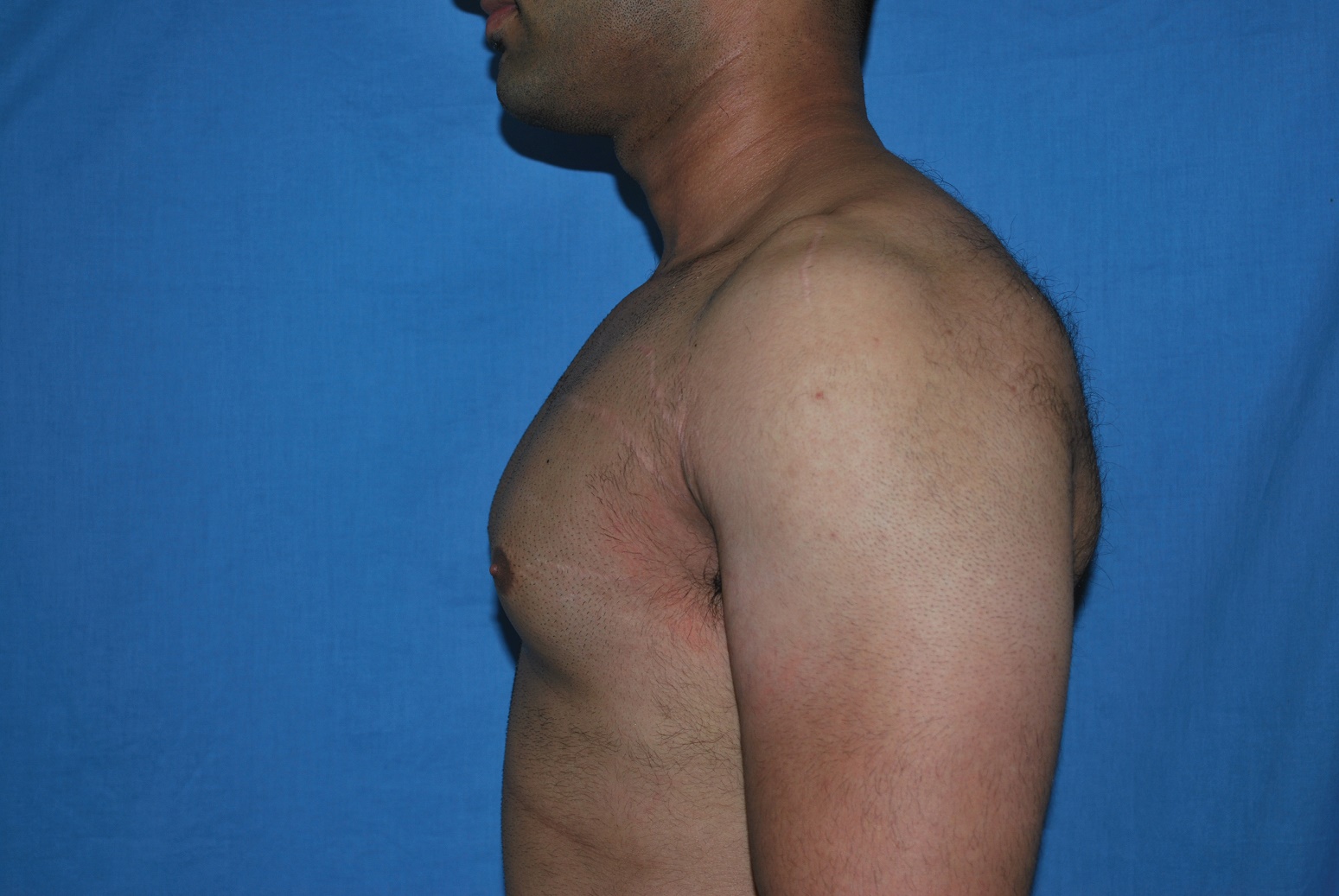 Male Breast Reduction Patient Photo - Case 5042 - before view-1