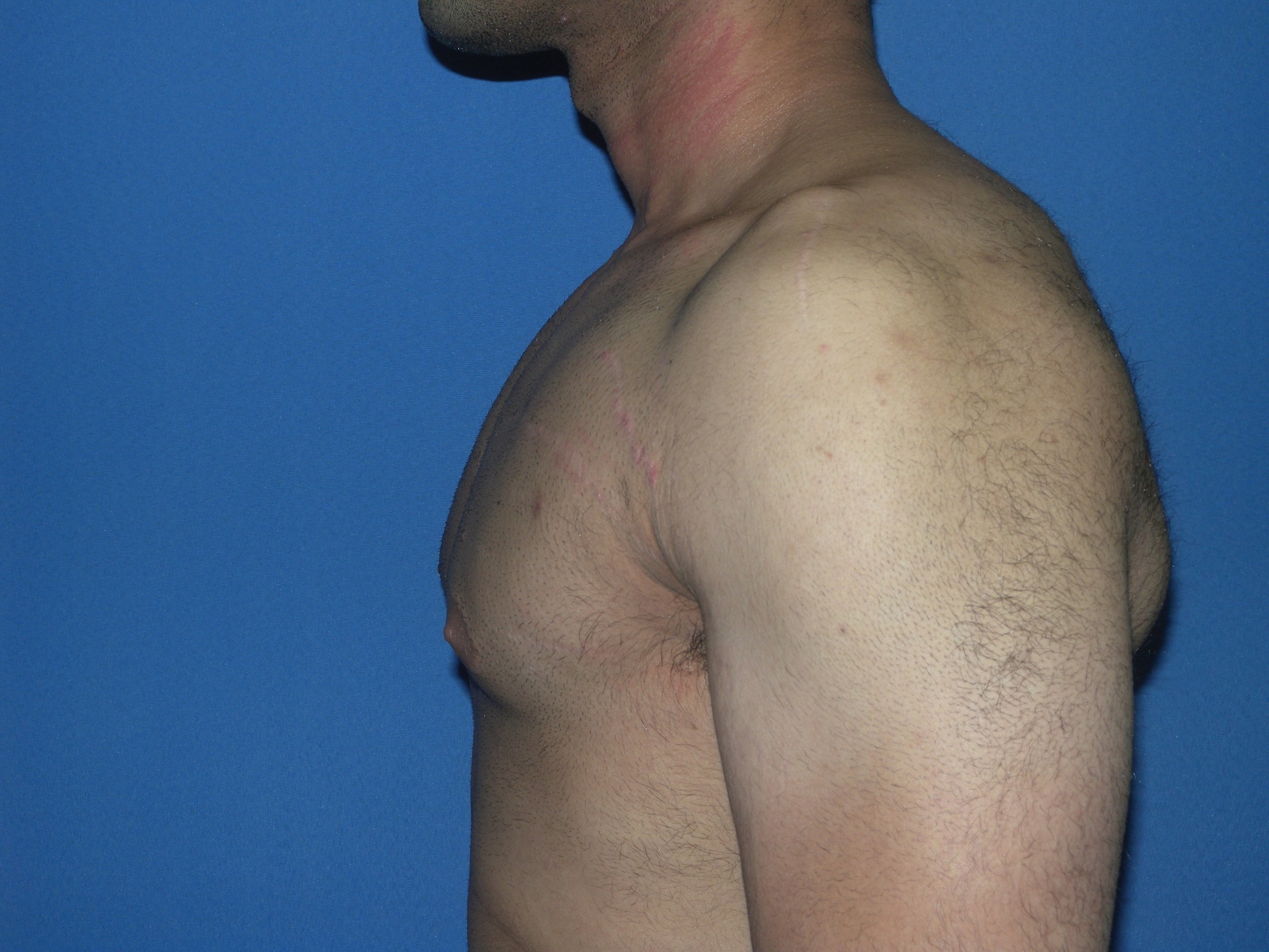 Male Breast Reduction Patient Photo - Case 5042 - after view-1