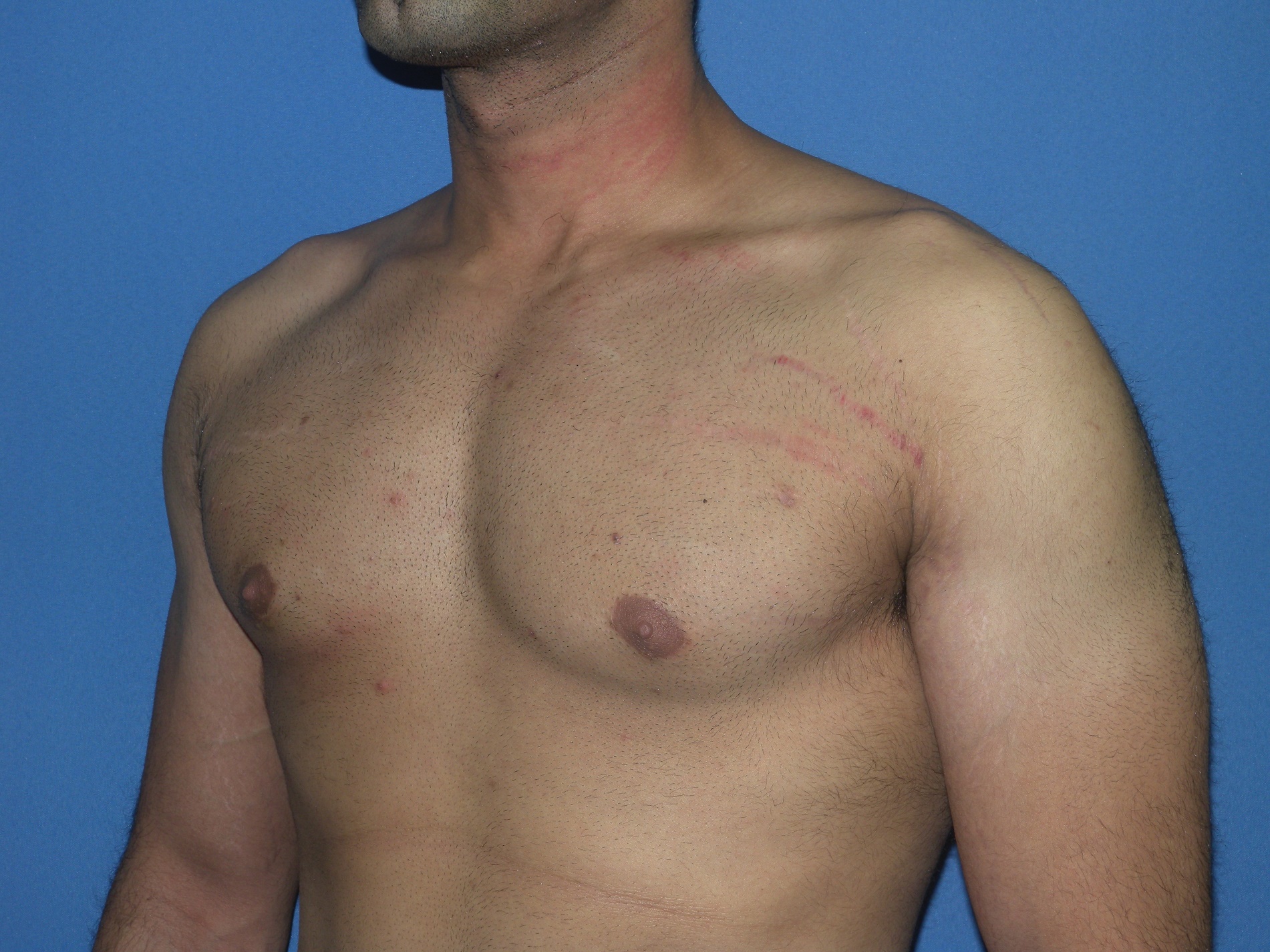 Male Breast Reduction Patient Photo - Case 5042 - after view-2