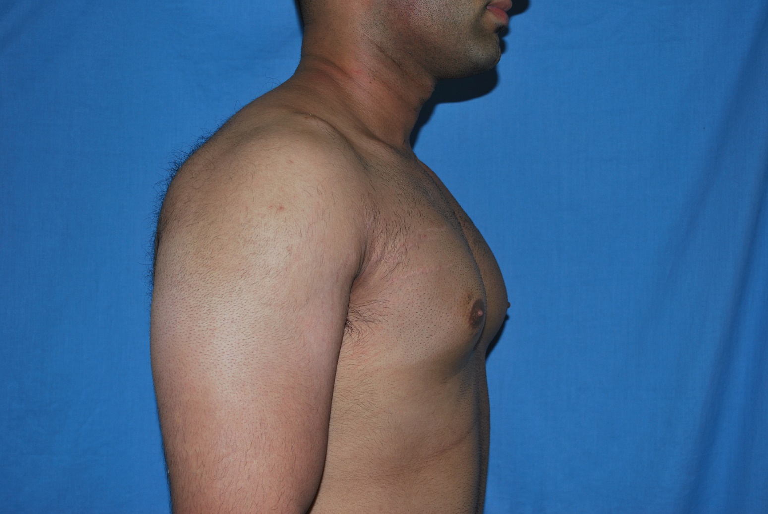 Male Breast Reduction Patient Photo - Case 5042 - before view-3