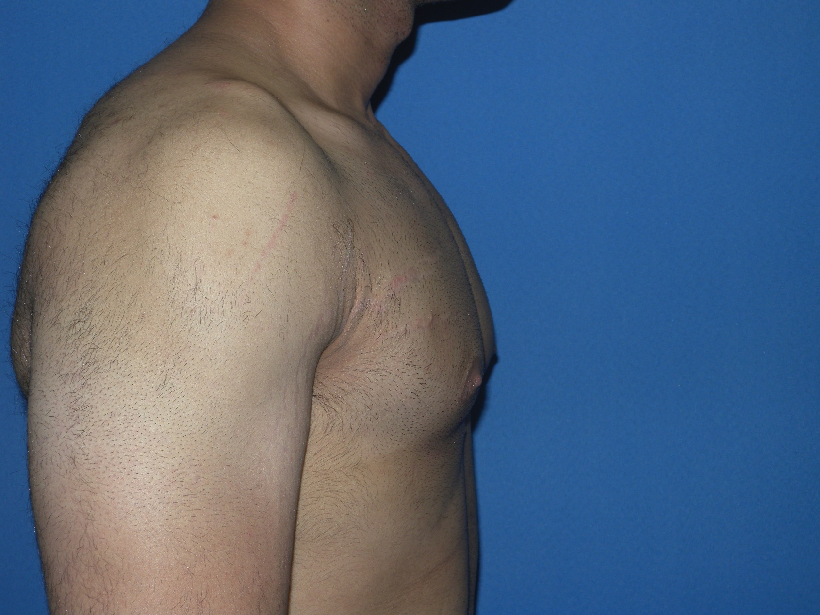Male Breast Reduction Patient Photo - Case 5042 - after view-3