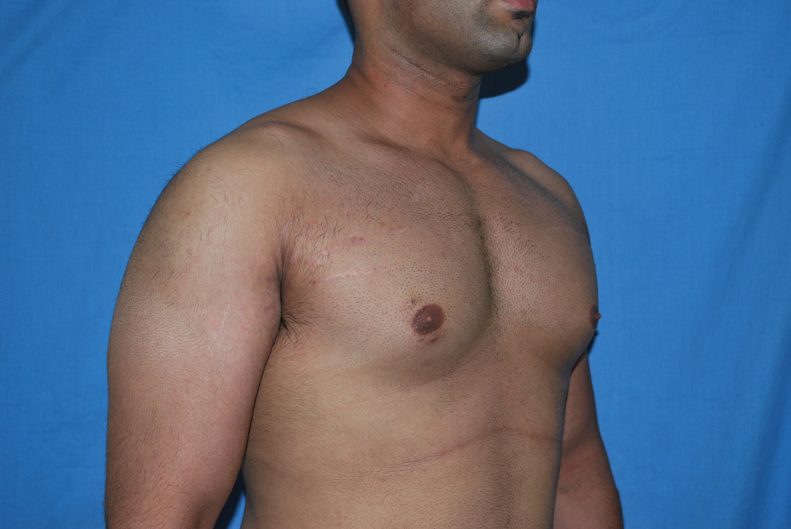 Male Breast Reduction Patient Photo - Case 5042 - before view-4