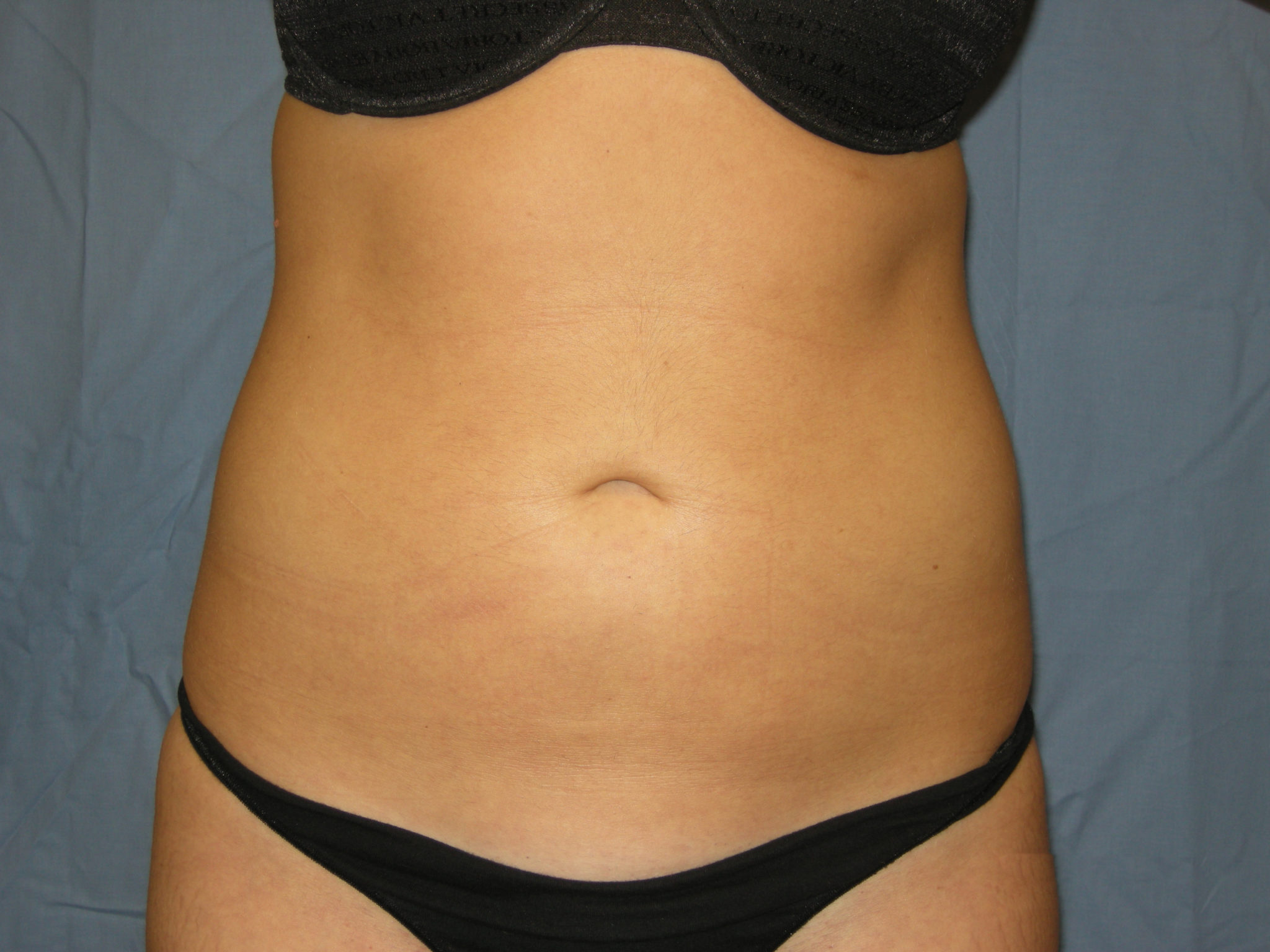 Liposuction Patient Photo - Case 3237 - after view
