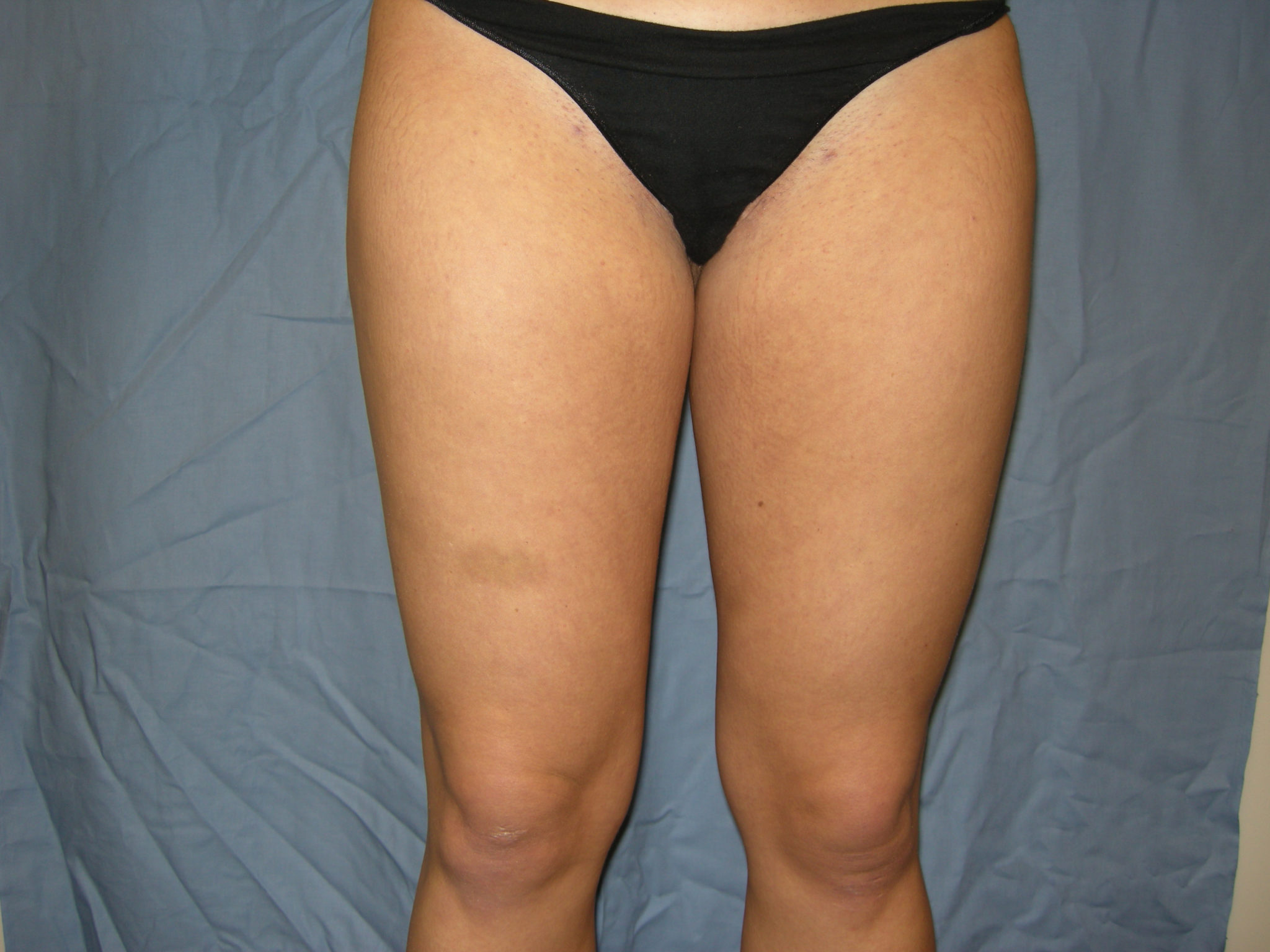 Liposuction Patient Photo - Case 3237 - after view-1