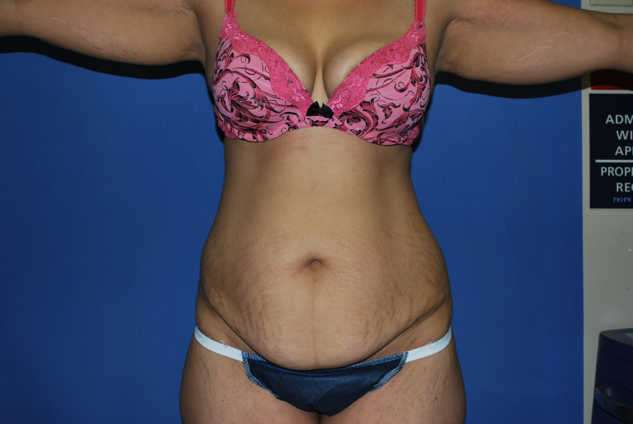Tummy Tuck Patient Photo - Case 3422 - before view-