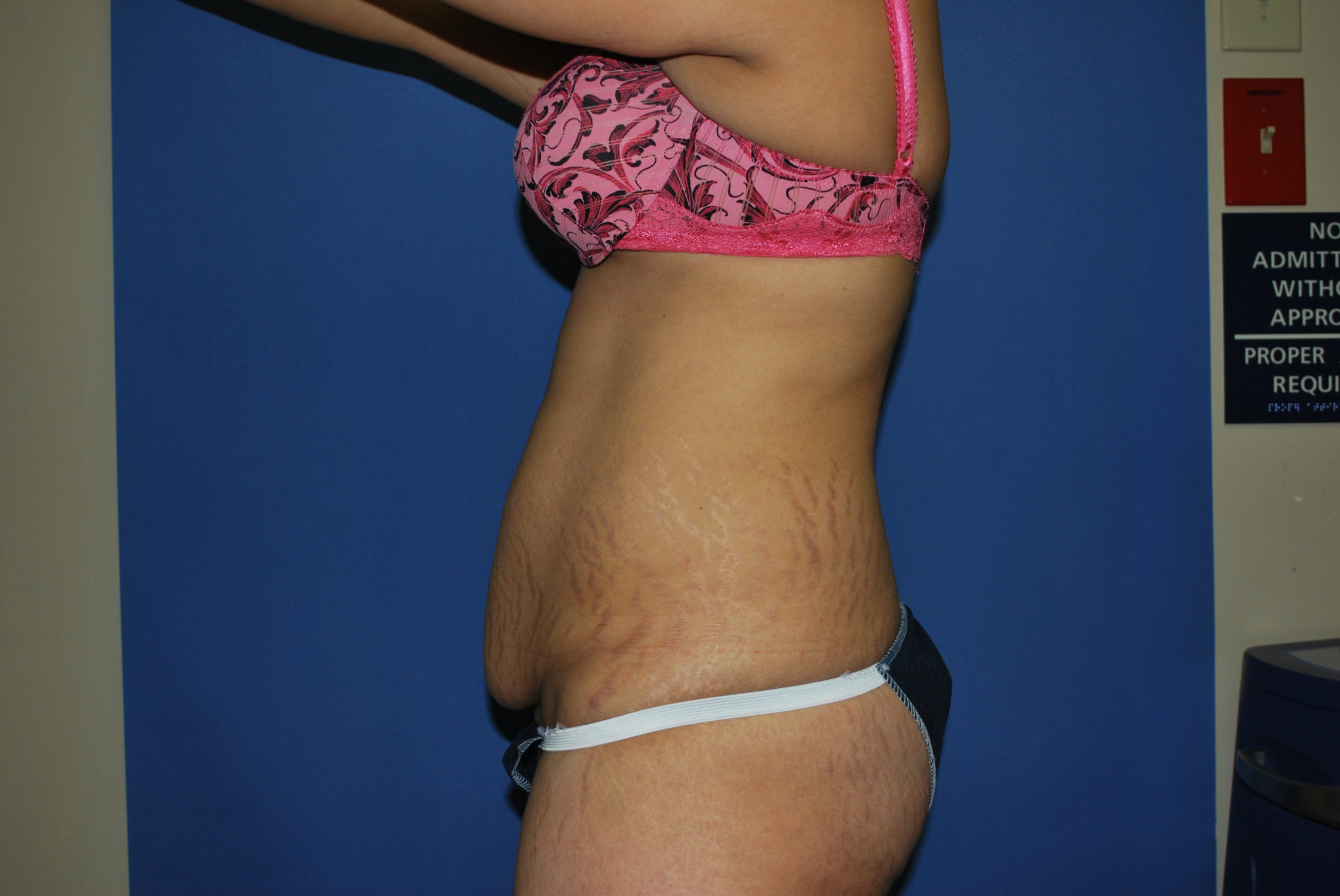 Tummy Tuck Patient Photo - Case 3422 - before view-1