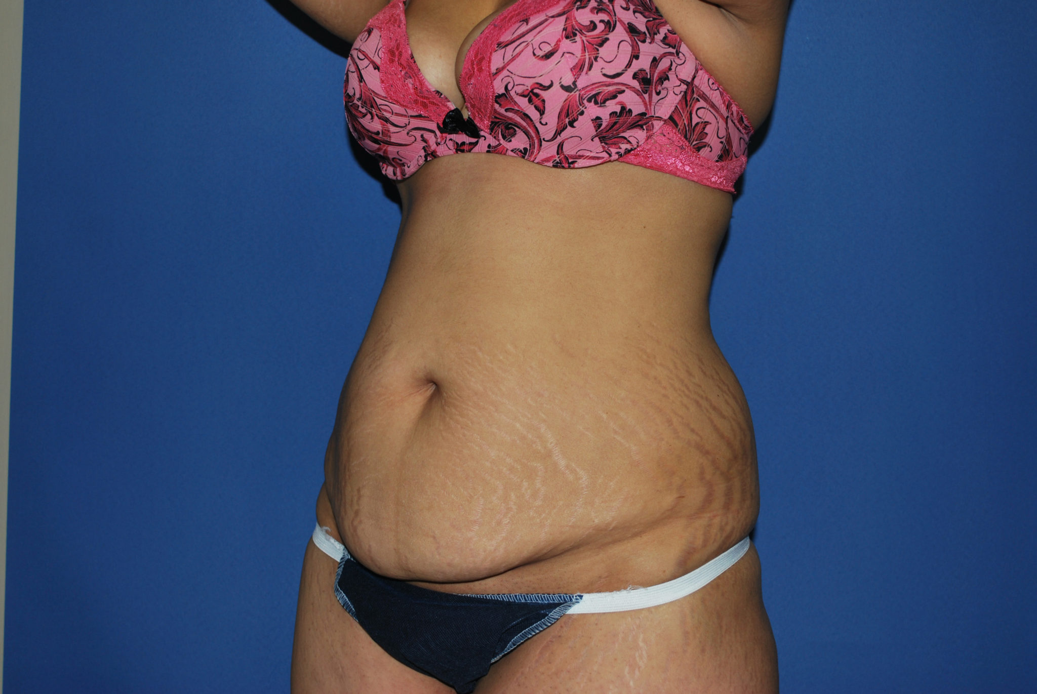 Tummy Tuck Patient Photo - Case 3422 - before view-2