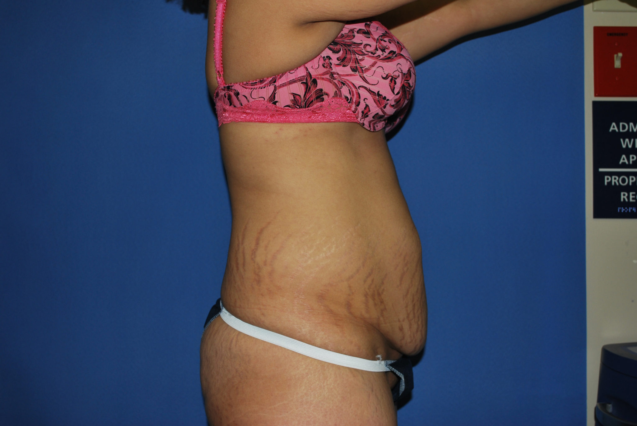 Tummy Tuck Patient Photo - Case 3422 - before view-3